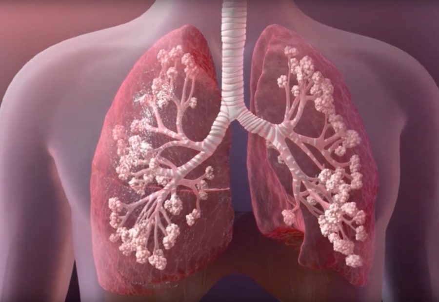 Kistik Fibrozis Hastalığı Nedir, Belirtileri Nelerdir, Ölüm Riski Oranı Nedir?