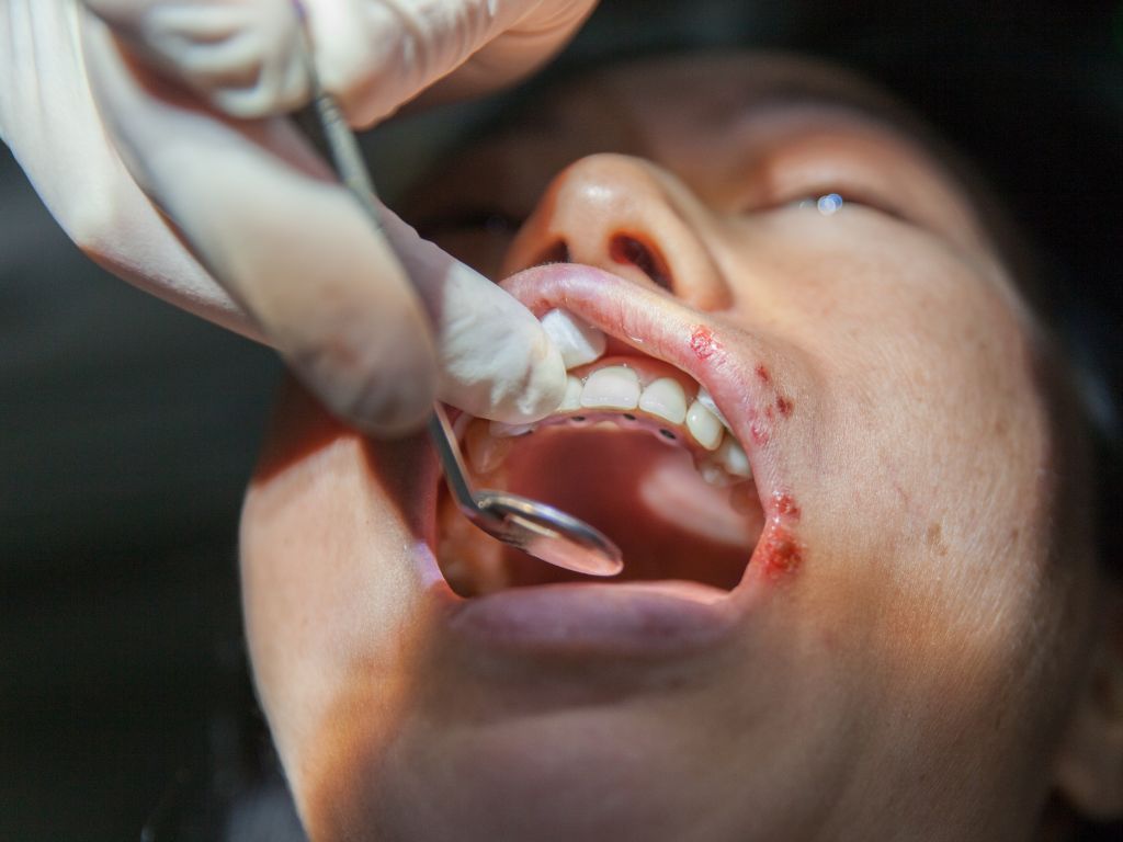 Ağız Kanseri nedir? Ağız Kanseri nasıl geçer? Ağız Kanseri tedavisi ne? Ağız Kanserinin belirtileri nelerdir? Ağız Kanseri neden olur? Ağız kanseri öldürür mü? Ağız kanseri için hangi doktora gidilir?