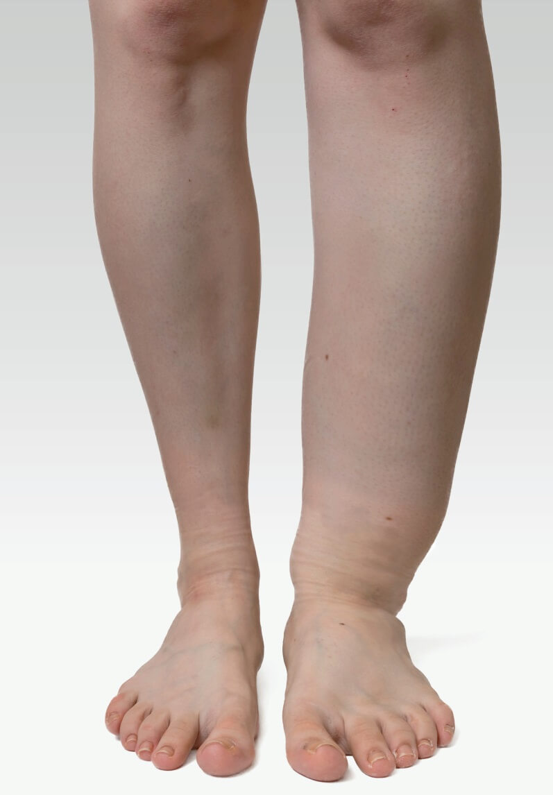 Fil Hastalığı (Lenfödem) nedir? Fil hastalığının belirtileri nelerdir? Fil hastalığı neden olur? Fil hastalığının çeşitleri nelerdir? Fil hastalığının teşhisi nasıl konulur? Fil hastalığının tedavisi nedir?