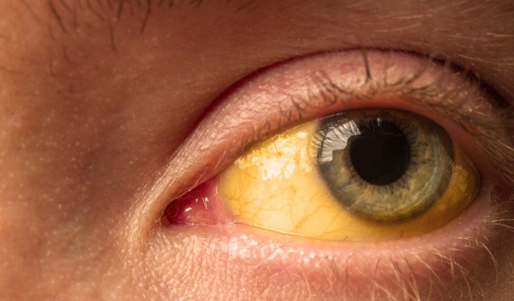 Sarılık nedir? Sarılık nedenleri nelerdir? Sarılık belirtileri nelerdir? Sarılık için ne zaman doktora gitmek gerekir? Sarılık nasıl önlenir? Sarılık uyku yapar mı?