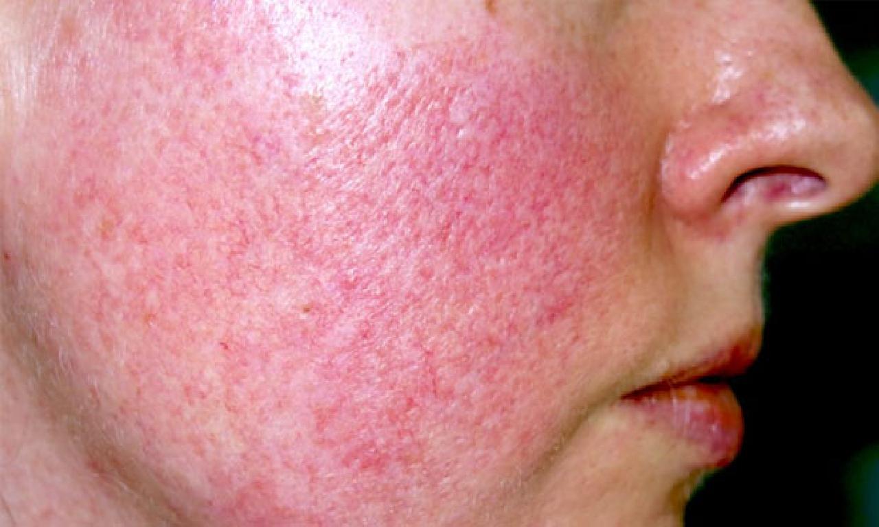 Gül Hastalığı (Rozasea) nedir? Gül hastalığı (Rozasea) Neden Olur? Gül hastalığı (Rozasea) Belirtileri Nelerdir? Gül Hastalığı (Rozasea) Nasıl Önlenir? Gül Hastalığını (Rozasea) İyi Gelen Yiyecekler neler? Gül hastalığı (Rozasea) Tedavisi nedir?