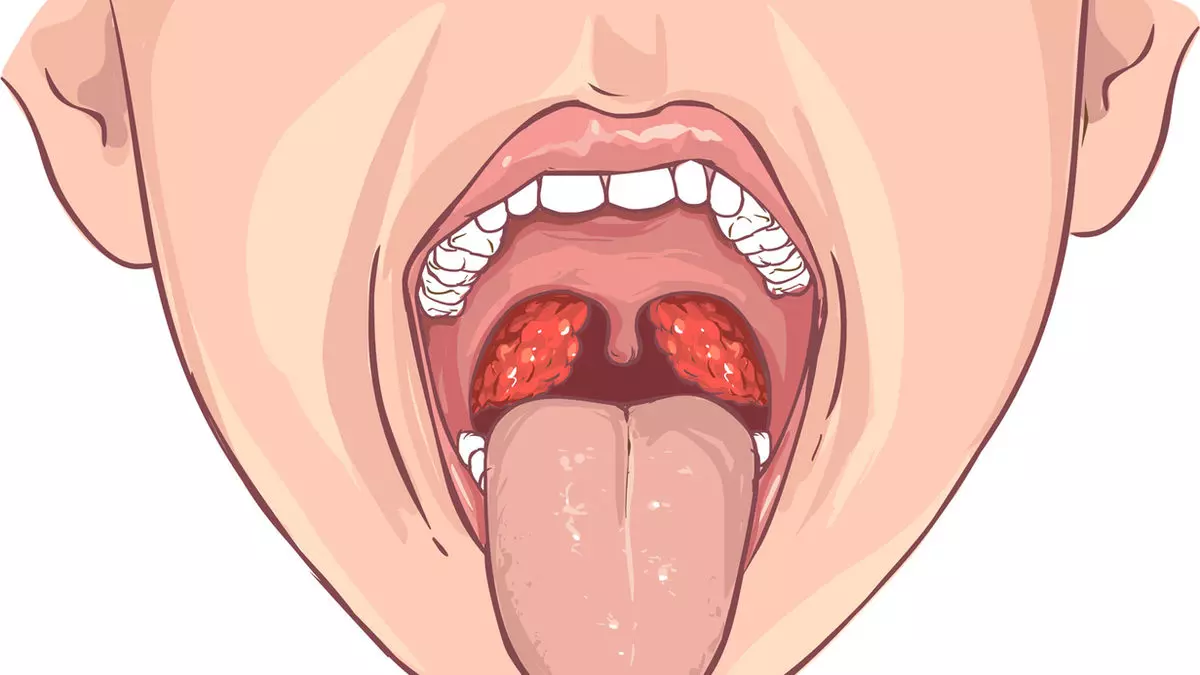 Farenjit nedir? Farenjit Çeşitleri Nelerdir? Farenjit Tedavisi nedir? Farenjit Nasıl Geçer? Farenjite Ne İyi Gelir? Farenjit Bulaşıcı Mıdır? Farenjit Nefes Darlığı ve Ateş Yapar mı?