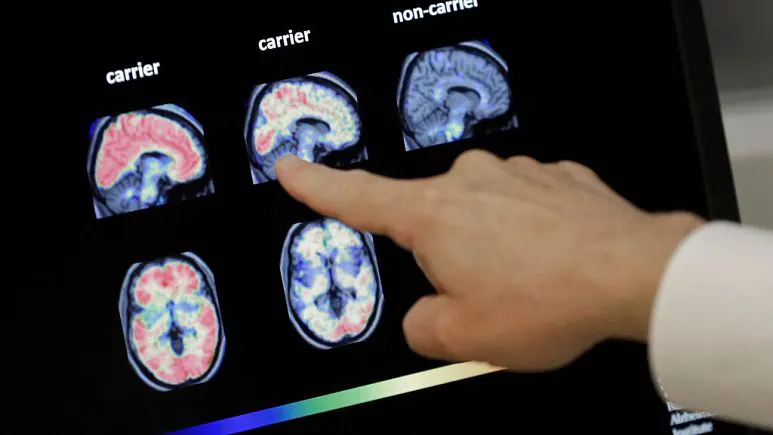 Alzheimer hastalığı için yeni geliştirilen 'lecanemab' adlı ilaca ilk onay