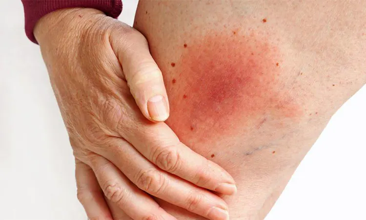 Lyme hastalığı nedir, belirtileri nelerdir? Lyme Hastalığı Neden Olur? Lyme Hastalığı Nasıl Önlenir?